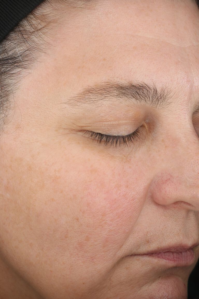 Day 1 of a woman B before application of Mary Kay TimeWise Miracle Set.