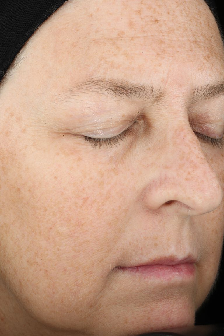 Day 1 of woman A before application of Mary Kay TimeWise Miracle Set.