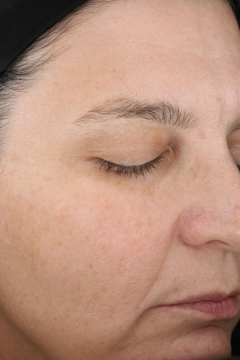 Week 12 of woman B after application of Mary Kay TimeWise Miracle Set.